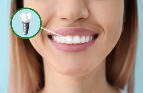 dental implants near me