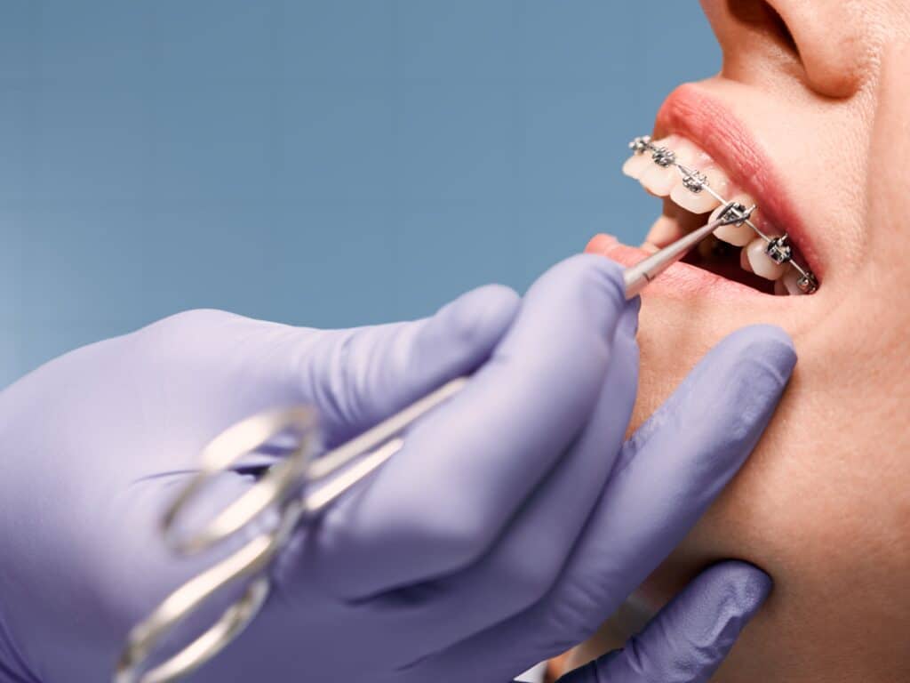 Braces Southgate