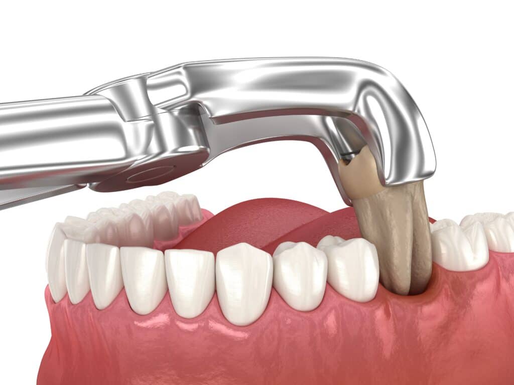 wisdom teeth removal near Southgate